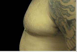 Gynecomastia Before and After Pictures West Palm Beach, FL (Dr. Pillersdorf)