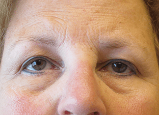 Blepharoplasty Before and After Pictures West Palm Beach, FL (Dr. Hayn)