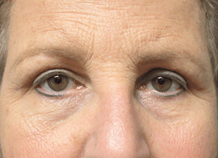 Blepharoplasty Before and After Pictures West Palm Beach, FL (Dr. Hayn)