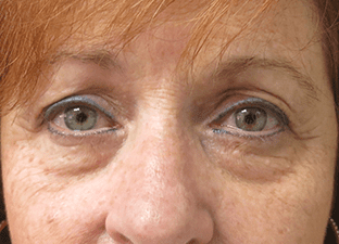 Blepharoplasty Before and After Pictures West Palm Beach, FL (Dr. Pillersdorf)