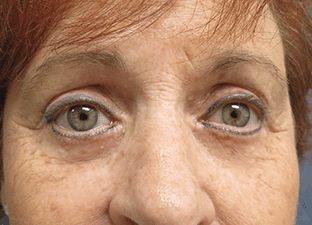 Blepharoplasty Before and After Pictures West Palm Beach, FL (Dr. Pillersdorf)