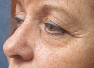 Blepharoplasty Before and After Pictures West Palm Beach, FL (Dr. Pillersdorf)