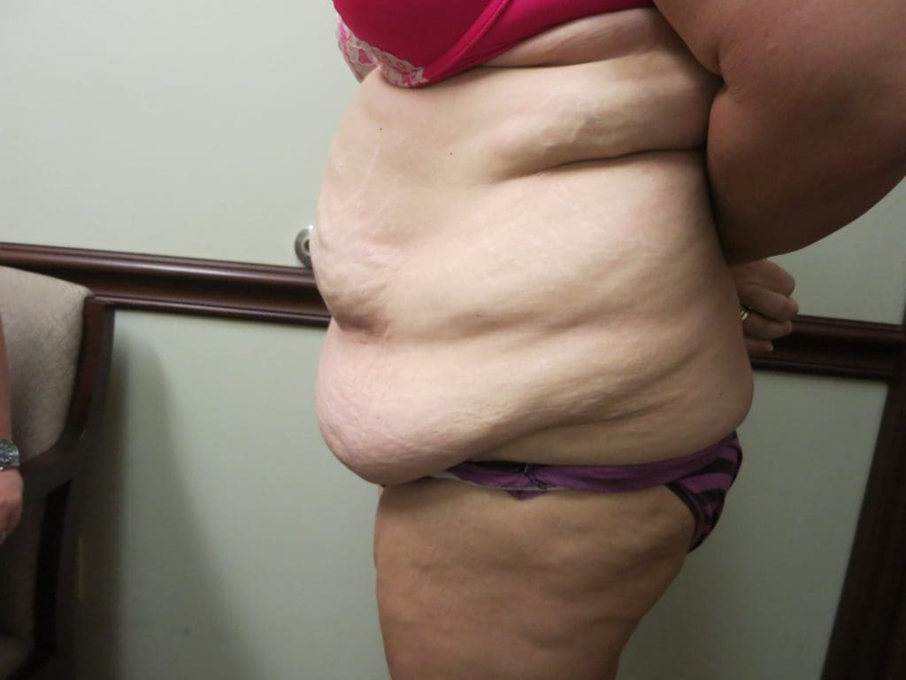 Abdominoplasty Breast Augmentation Before and After Pictures West Palm Beach, FL