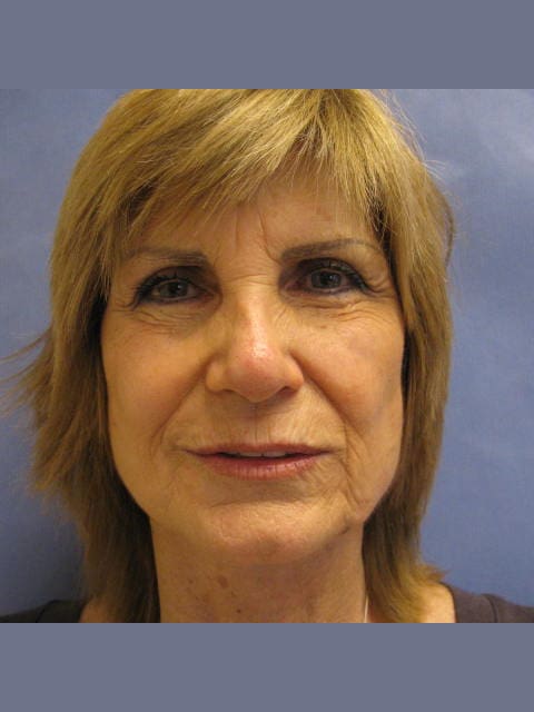 Facelift Before and After Pictures West Palm Beach, FL