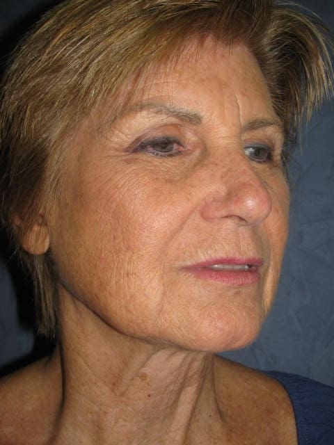 Facelift Before and After Pictures West Palm Beach, FL