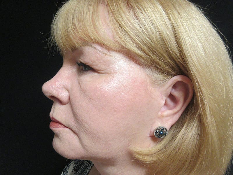 Facelift Case Before and After Pictures West Palm Beach, FL