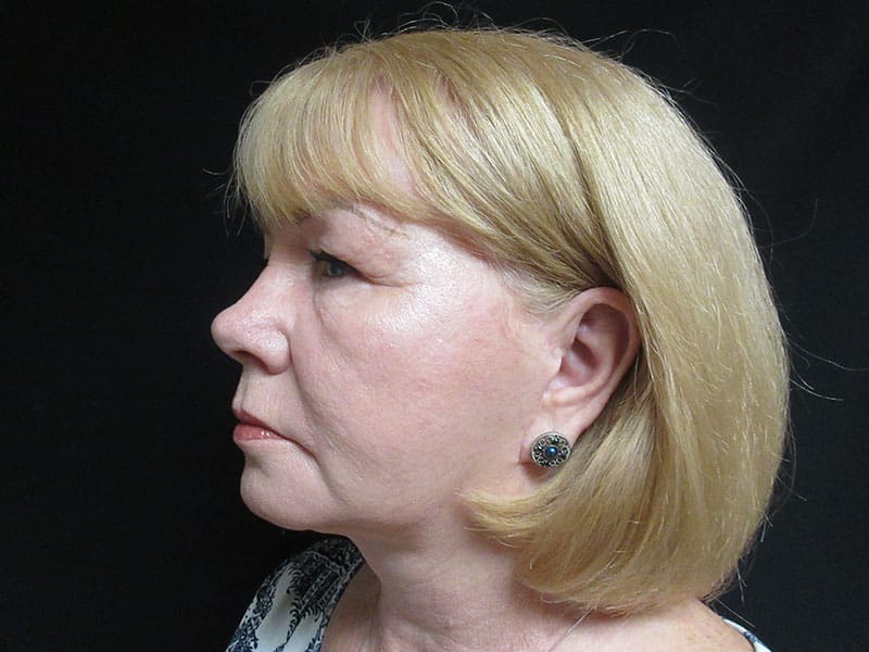 Facelift Case Before and After Pictures West Palm Beach, FL