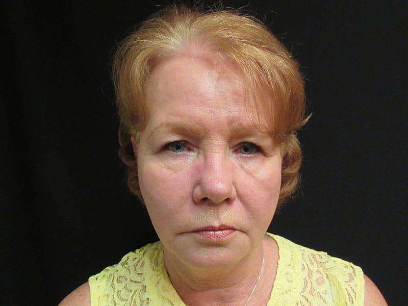 Facelift Case Before and After Pictures West Palm Beach, FL