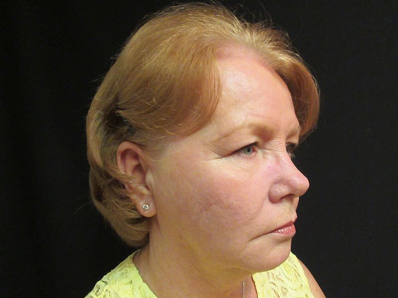 FaceLift Before and After Pictures in West Palm Beach, FL