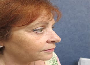 Blepharoplasty Before and After Pictures West Palm Beach, FL (Dr. Pillersdorf)