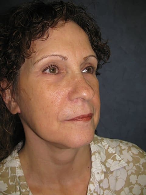 FaceLift Before and After Pictures in West Palm Beach, FL