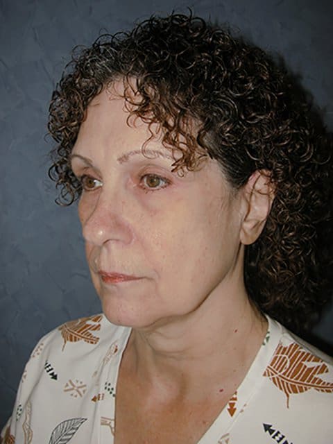 FaceLift Before and After Pictures in West Palm Beach, FL