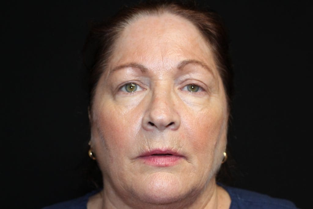 Blepharoplasty Before and After Pictures West Palm Beach, FL