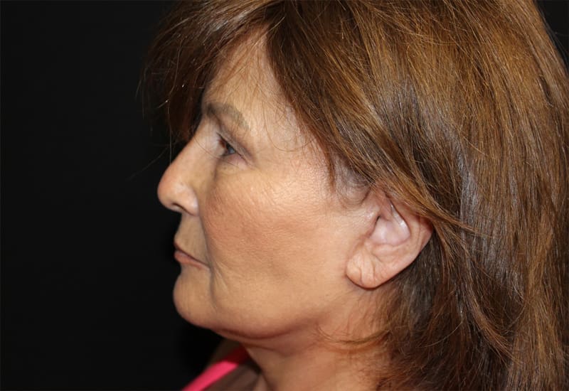 Facelift Before and After Pictures West Palm Beach, FL