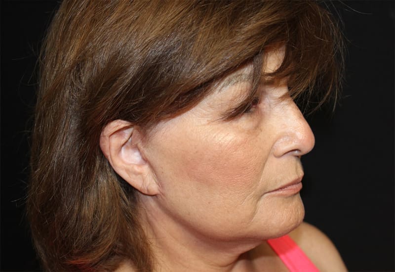 Facelift Before and After Pictures West Palm Beach, FL