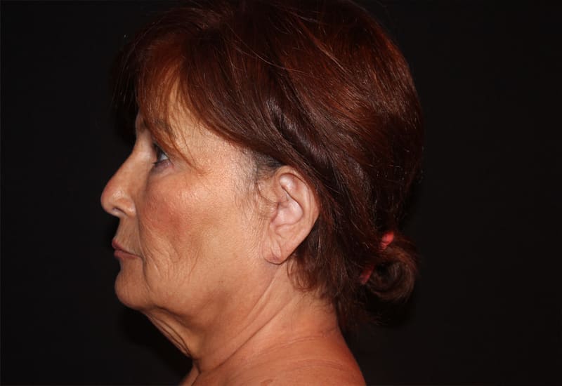 Facelift Before and After Pictures West Palm Beach, FL