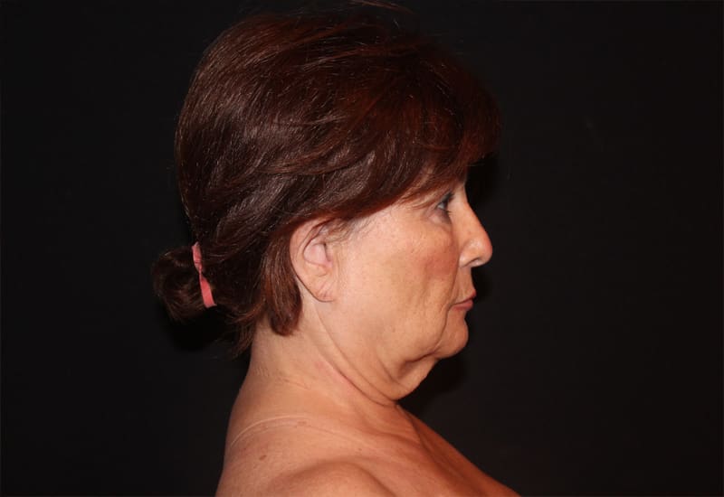 Facelift Before and After Pictures West Palm Beach, FL