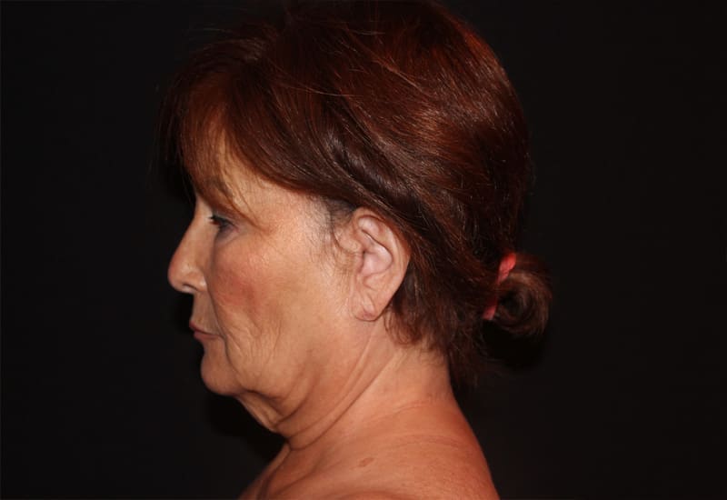 Facelift Before and After Pictures West Palm Beach, FL