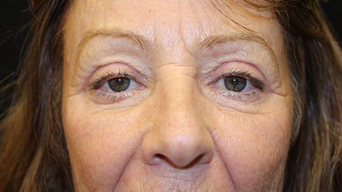 Blepharoplasty Upper and Lower Before and After Pictures in West Palm Beach, FL