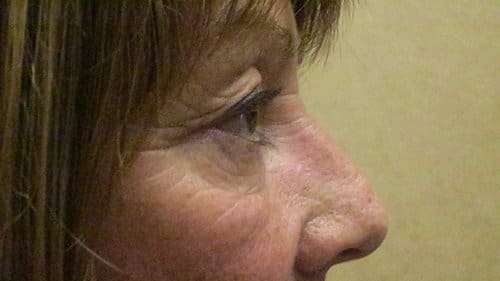 Blepharoplasty Upper and Lower Before and After Pictures in West Palm Beach, FL