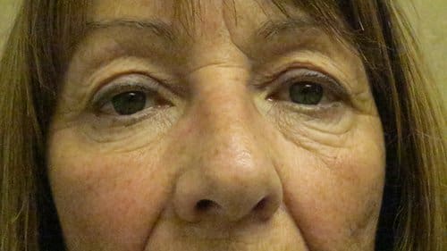 Blepharoplasty Upper and Lower Before and After Pictures in West Palm Beach, FL