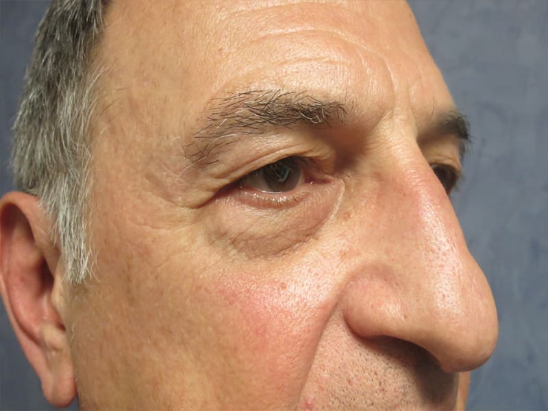 Blepharoplasty Before and After Pictures West Palm Beach, FL