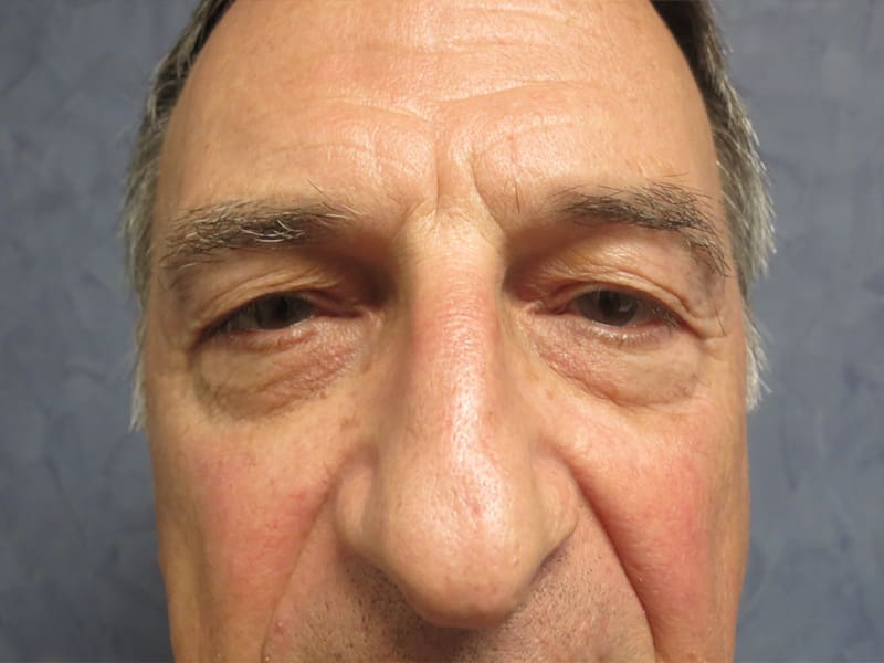 Blepharoplasty Before and After Pictures West Palm Beach, FL