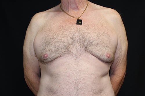 Gynecomastia Before and After Pictures in West Palm Beach, FL