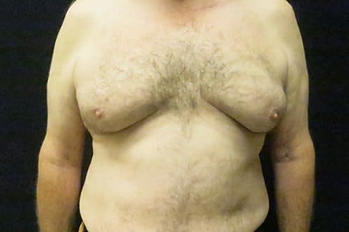 Gynecomastia Before and After Pictures in West Palm Beach, FL