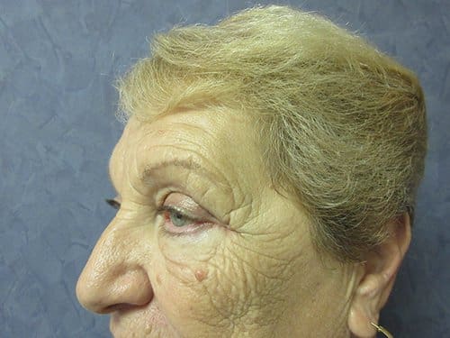 Blepharoplasty Before and After Pictures in West Palm Beach, FL