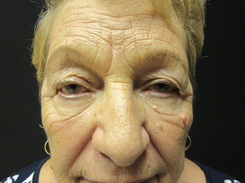 Blepharoplasty Before and After Pictures in West Palm Beach, FL