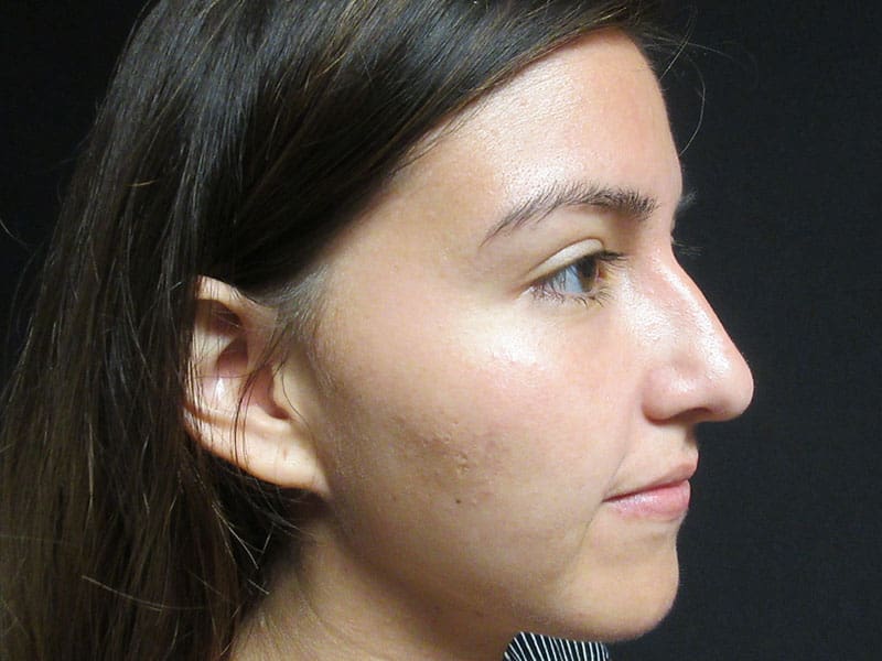 Rhinoplasty Before and After Pictures West Palm Beach, FL