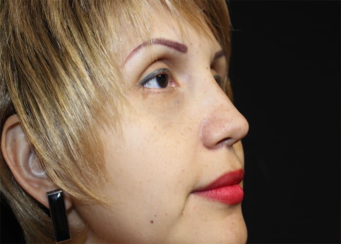 Rhinoplasty Before and After Pictures West Palm Beach, FL