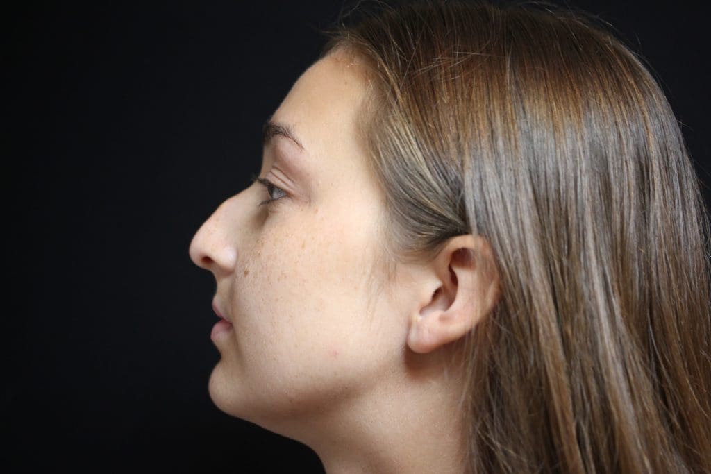 Rhinoplasty Before and After Pictures West Palm Beach, FL