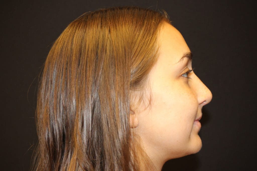 Rhinoplasty Before and After Pictures West Palm Beach, FL