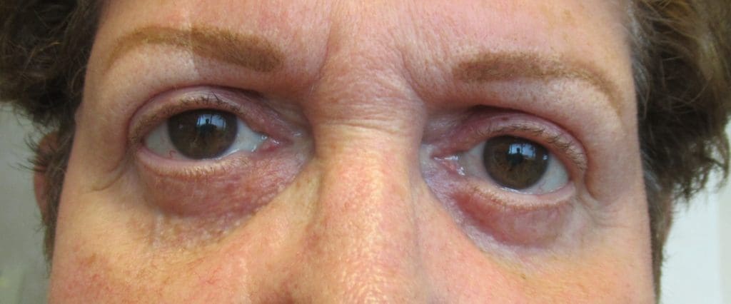 Blepharoplasty Before and After Pictures West Palm Beach, FL