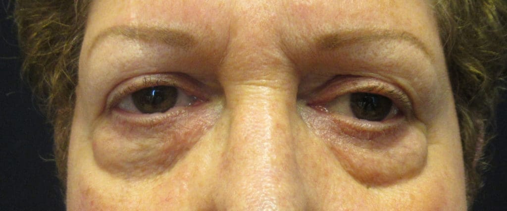 Blepharoplasty Before and After Pictures West Palm Beach, FL