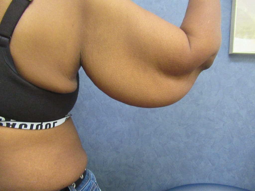 Brachioplasty Before and After Pictures West Palm Beach, FL