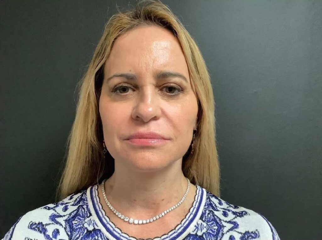 Facelift Before and After Pictures West Palm Beach, FL