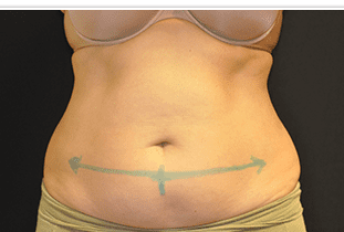 CoolSculpting Before and After Pictures West Palm Beach, FL