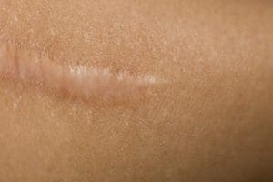 Scar Treatment in West Palm Beach and Jupiter, FL