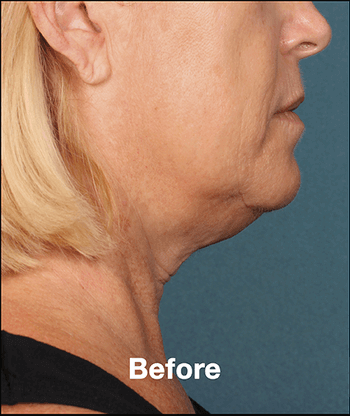 Kybella Before and After Pictures West Palm Beach, FL