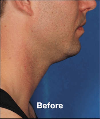 Kybella Before and After Pictures West Palm Beach, FL