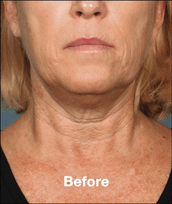 Kybella Before and After Pictures West Palm Beach, FL