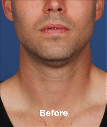 Kybella Before and After Pictures West Palm Beach, FL