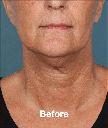 Kybella Before and After Pictures West Palm Beach, FL